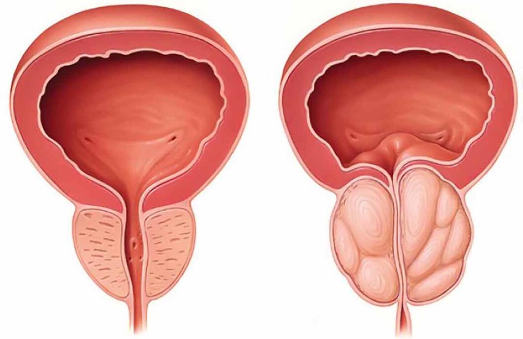 Prostate normale et inflammation de la prostate (prostatite chronique)
