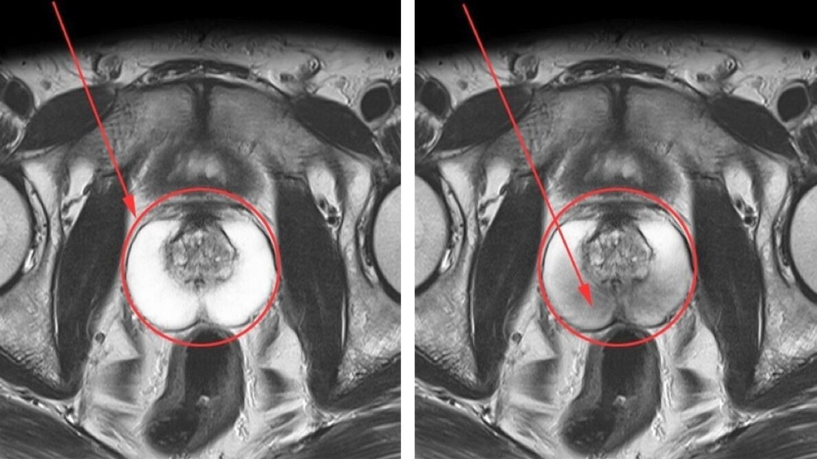 Échographie pour la prostatite chronique – prostate saine (à gauche) et enflammée (à droite)