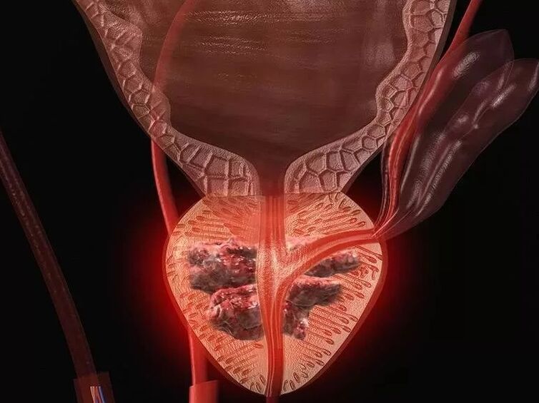 Prostatite chez les hommes