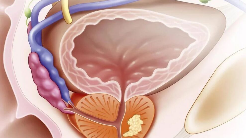 Prostatite chronique nébactérienne