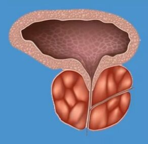 Signes caractéristiques de la prostatite