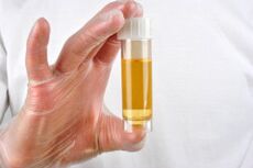 L'analyse d'urine est l'une des méthodes de diagnostic de la prostatite