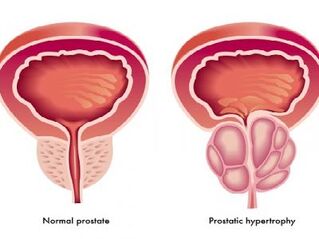Prostate normale et enflammée