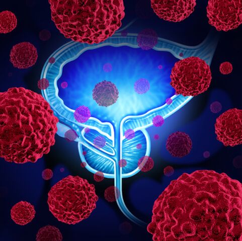 L'activité des micro-organismes pathogènes est à l'origine du développement de la prostatite