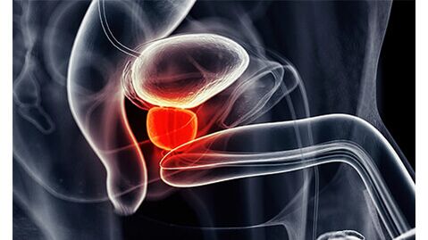 Inflammation de la glande de la prostate