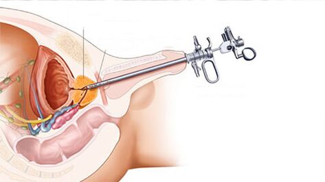 Traitement chirurgical de la prostatite