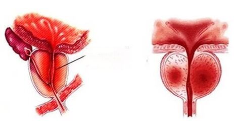 À quoi ressemble la prostatite chronique